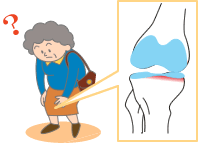変形性膝関節症：初期