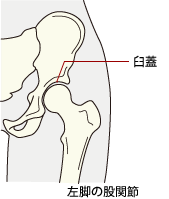 股関節 臼 蓋 形成 不全
