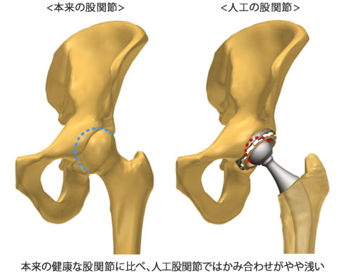 股関節と人工股関節の図