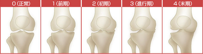 変形性膝関節症5段階