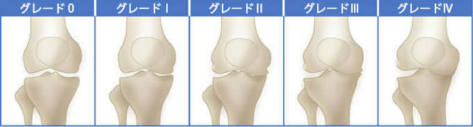 変形性膝関節症5段階（左から　グレードⅠ、Ⅱ、Ⅲ、Ⅳ）