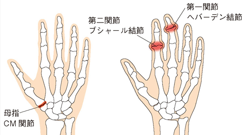手指の変形性関節症