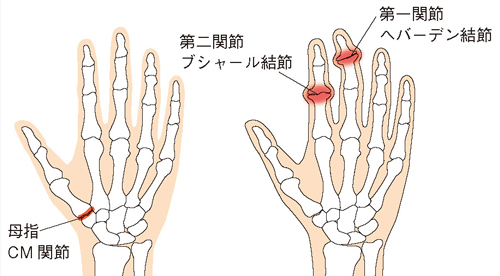 手指の変形性関節症に大きく影響する女性ホルモン（エストロゲン）の 