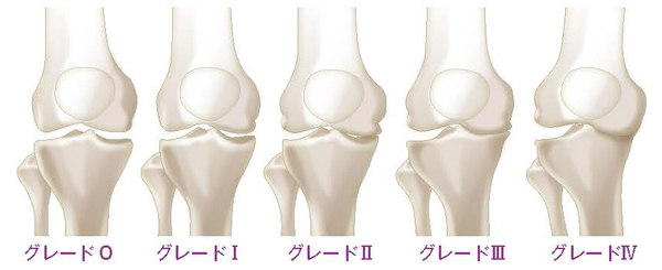 変形性膝関節症（グレード0～Ⅳ）