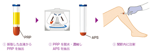 APS療法の流れ