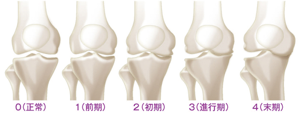 変形性膝関節症5 段階