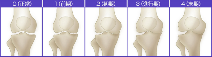 変形性膝関節症5段階