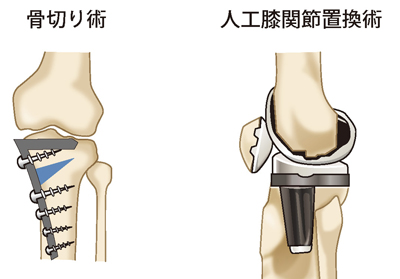 組骨切り術と人工膝関節置換術