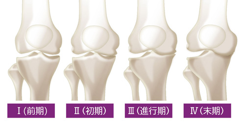 変形性膝関節症の進行