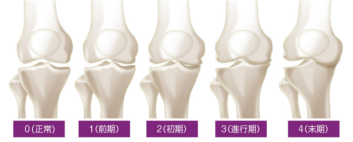 変形性膝関節症5段階