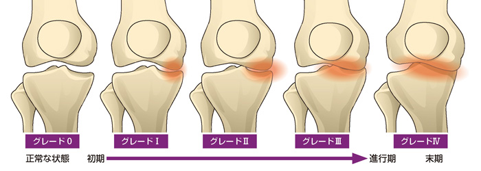 変形性膝関節症の進行程度