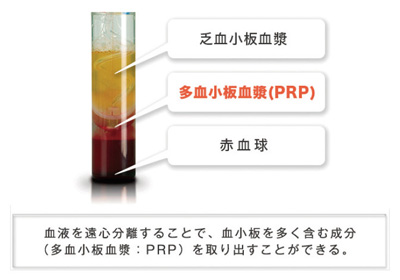 PRP分離のイメージ