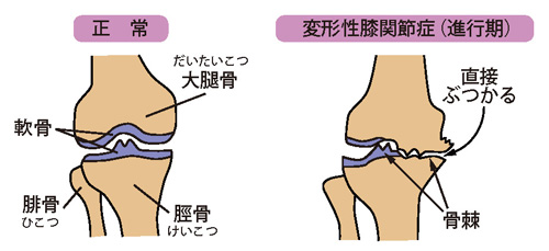 正常な状態と変形性膝関節症（進行期）