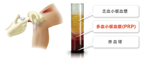 PRP（多血小板血漿）療法イメージ