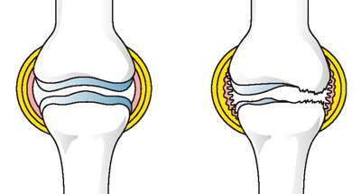 正常な膝（左）と炎症のおきた膝（右）