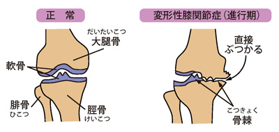 正常な膝（左）と変形性膝関節症（進行期）（右）