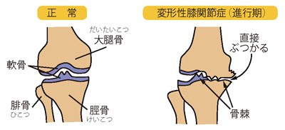 正常な膝（左）と変形性膝関節症（進行期）（右）