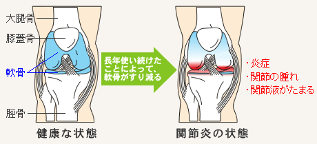 健康な状態の膝関節と関節炎の状態