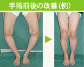 手術前後のＯ脚の改善